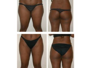 Avant après liposuccion cuisses