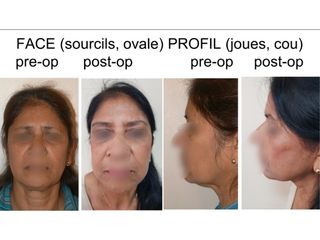 Avant après lifting fronto-cervico-facial par fils tenseurs