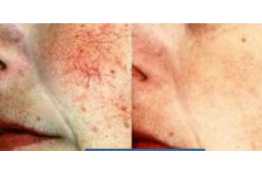 Laser dermatologique avant et après - 555492