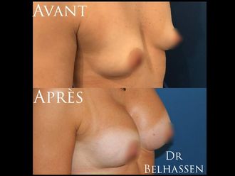 Augmentation mammaire - 628027