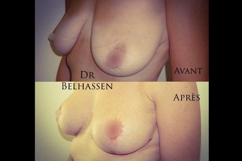 Implants mammaires avant et après - 628028