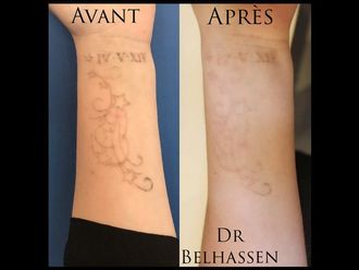 Détatouage - 628029
