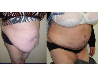 Avant après Abdominoplastie