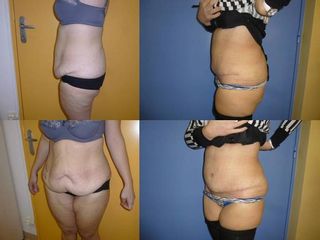 Avant après Abdominoplastie