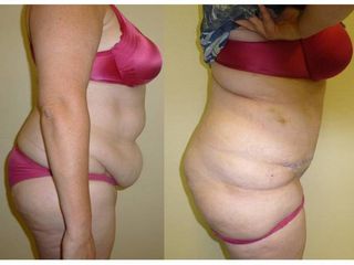 Avant après Abdominoplastie