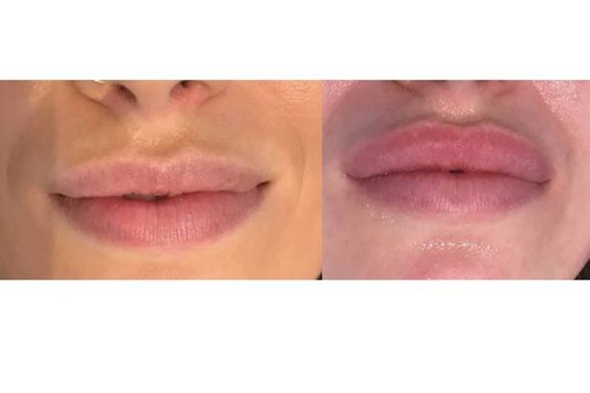 Augmentation des lèvres avant et après - 629785