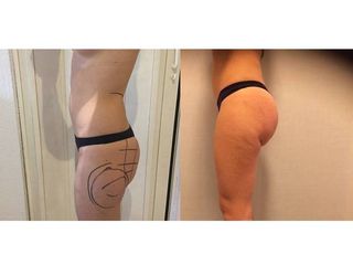 Avant après Lipofilling