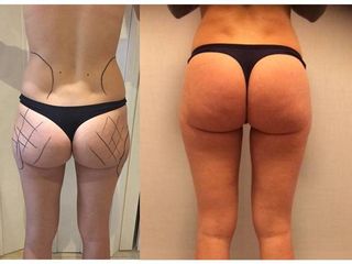 Avant après Lipofilling
