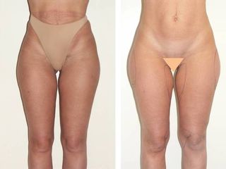 Avant après Liposuccion