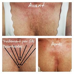 Fils tenseurs - Dr Catherine Pannacci - Mandelieu Esthétique