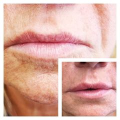 Augmentation des lèvres - Dr Catherine Pannacci - Mandelieu Esthétique