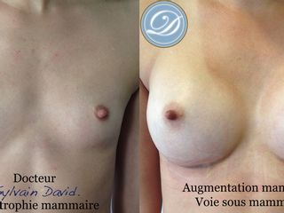 Avant après augmentation mammaire