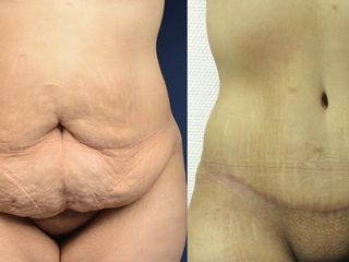 Avant après Abdominoplastie