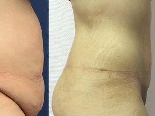 Avant après Abdominoplastie