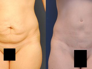 Avant après Abdominoplastie