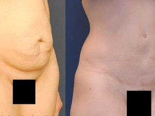 Avant après Abdominoplastie