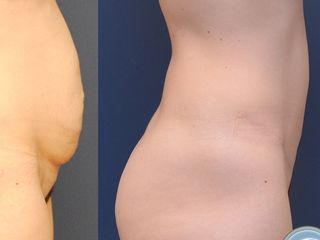 Avant après Abdominoplastie