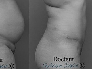 Avant après Abdominoplastie