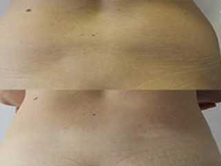 Avant après liposuccion flancs