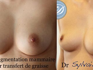 Avant après Lipofilling mammaire