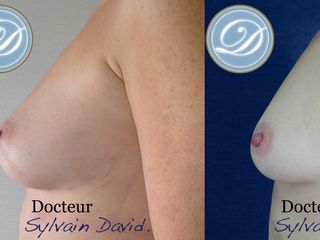 Avant après Lipofilling mammaire