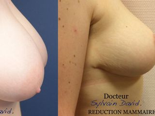 Avant après Lipofilling mammaire