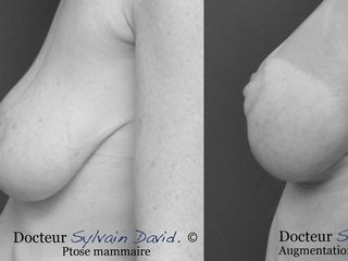 Avant après augmentation mammaire + lifting 