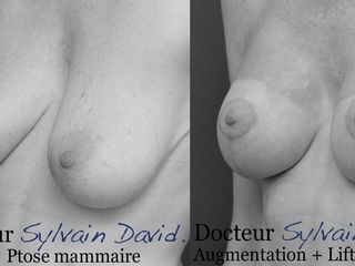 AUGMENTATION MAMMAIRE + LIFTING 3/4