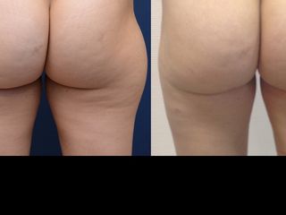 Avant après Liposuccion