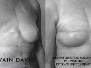 Avant après Reconstruction mammaire