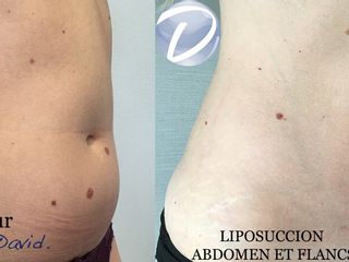 Avant après Liposuccion