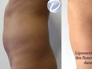 Avant après Liposuccion