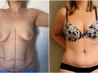 Abdominoplastie avant et après - 864089