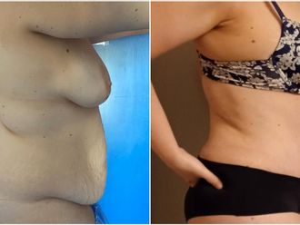 Abdominoplastie avant et après - 864090