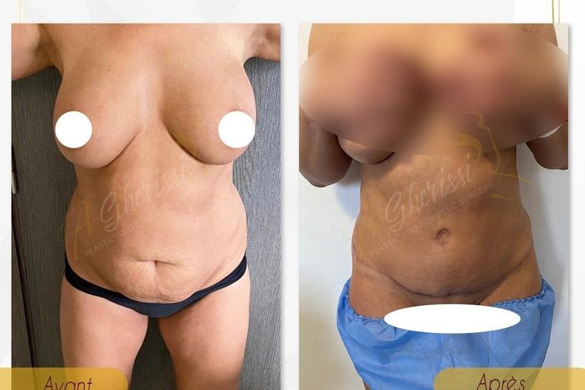Abdominoplastie avant et après - 864101
