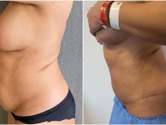 Abdominoplastie avant et après - 864103