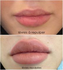Augmentation des lèvres - Dr Dahbia Montaigne