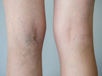 Varices - 563923