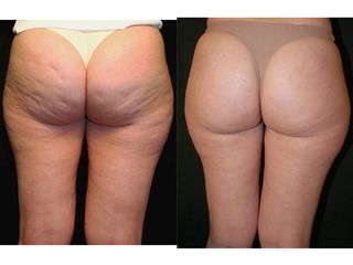 Avant après Traitement anti-cellulite