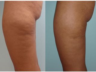 Avant après Traitement anti-cellulite