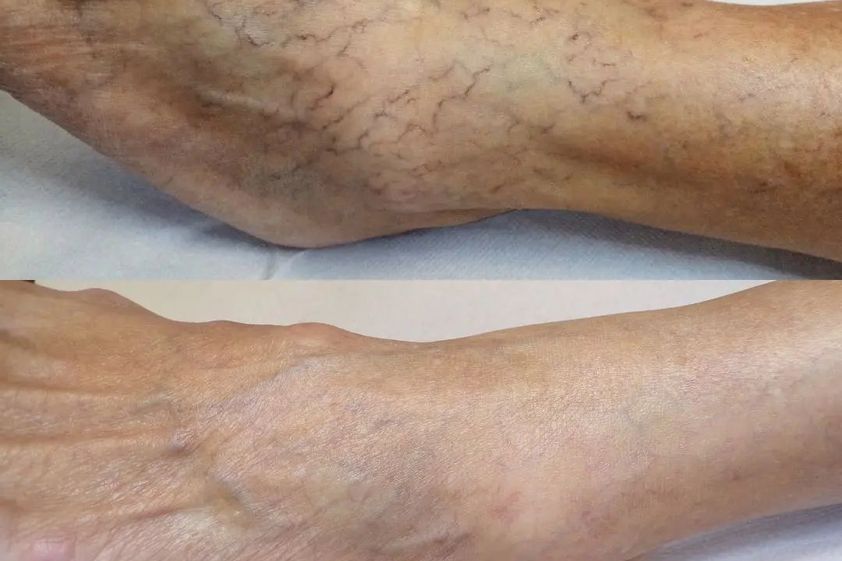 Varices avant et après - 830913