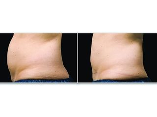Avant après Cryolipolyse