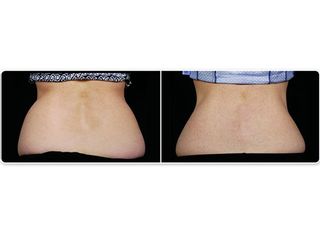 Avant après Cryolipolyse