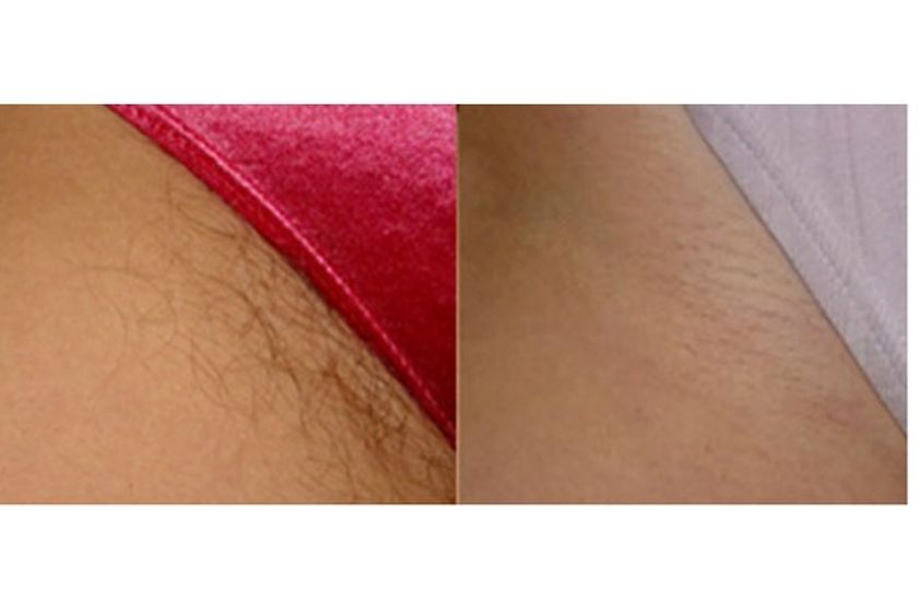 Épilation Laser avant et après - 475765