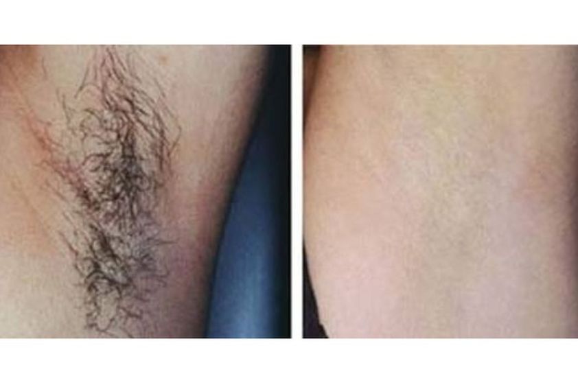 Épilation Laser avant et après - 475766