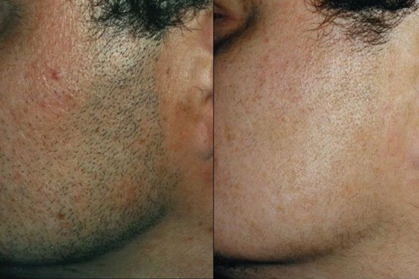Épilation Laser avant et après - 475767