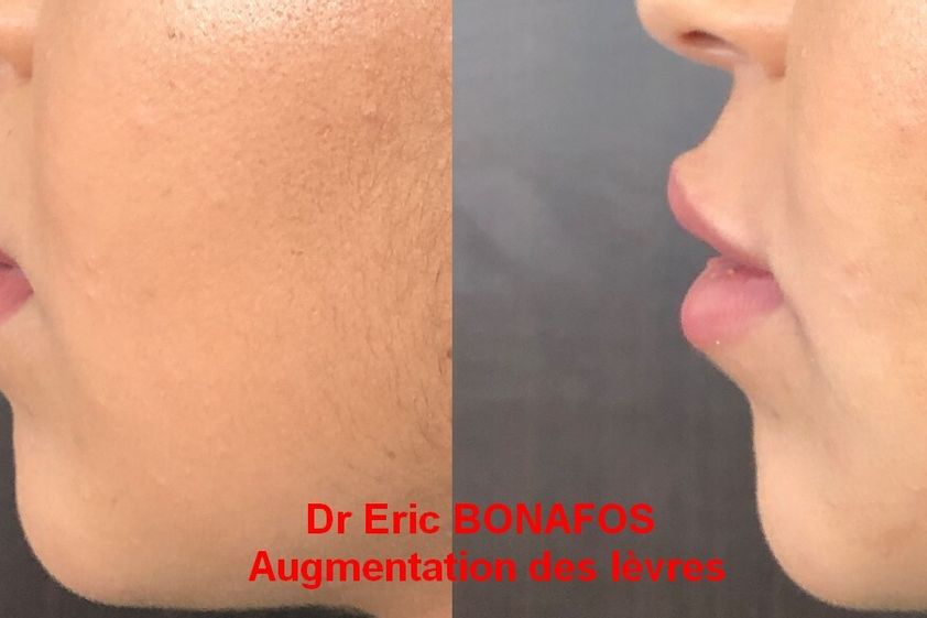 Augmentation des lèvres avant et après - 738719