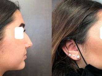 Rhinoplastie avant et après - 870379