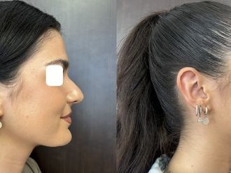 Rhinoplastie médicale avant et après - 870381