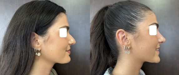 Rhinoplastie médicale - Dr Eric Bonafos